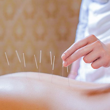 tratamentos saude bem-estar dry needling